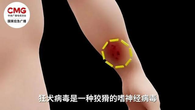 手臂肌腱被咬断！近期激增，半个月接诊近200例……
