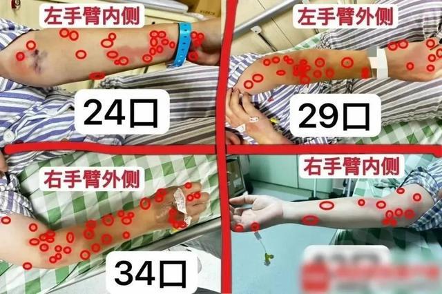 进入活跃期！4岁女童被叮咬后死亡 遇到它千万警惕……