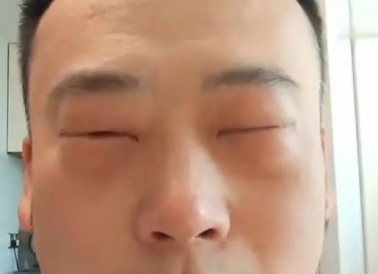 男子吃蝉蛹过敏眼睛肿成“奥特曼” 医生：高蛋白食物或危及生命
